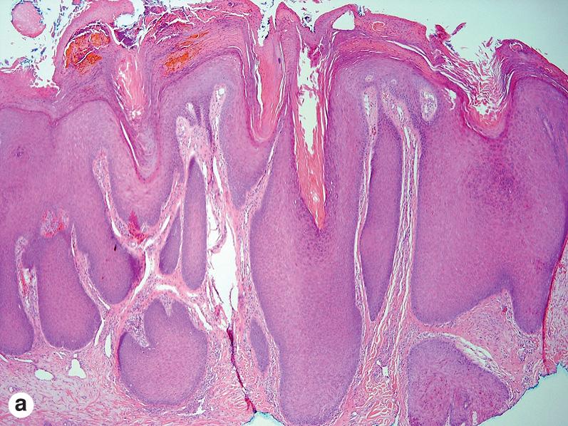 Fig. 1.29, (A) PEH, syringosquamous metaplasia after trauma. (B) Elastic fiber trapping in PEH