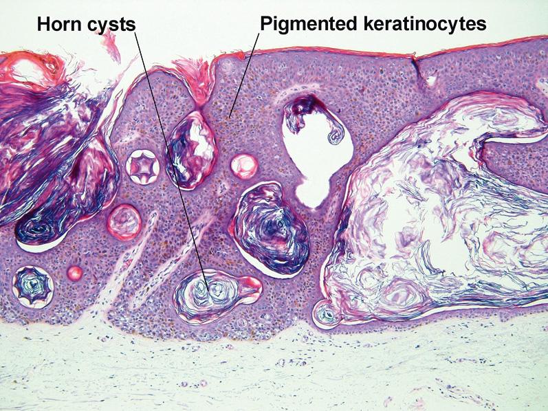 Fig. 1.30, Pseudohorn cyst, seborrheic keratosis
