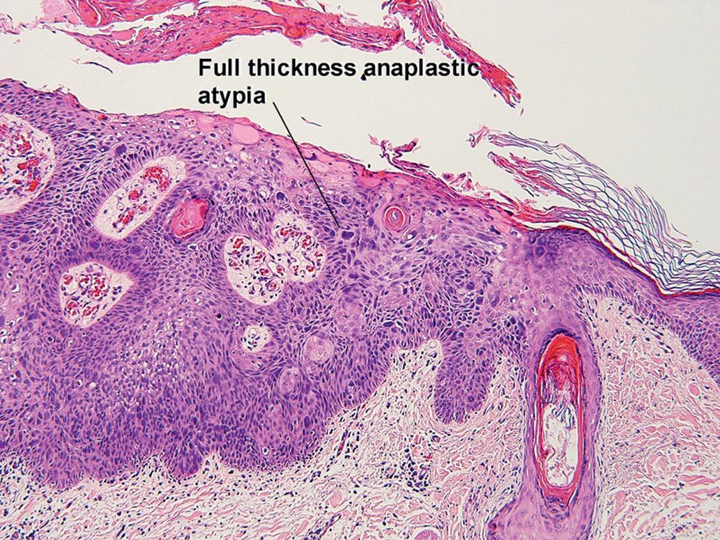 Fig. 1.3, Anaplasia, Bowen disease