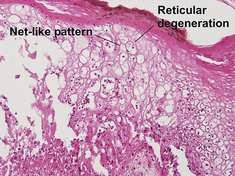 Fig. 1.31, Reticular degeneration, variola