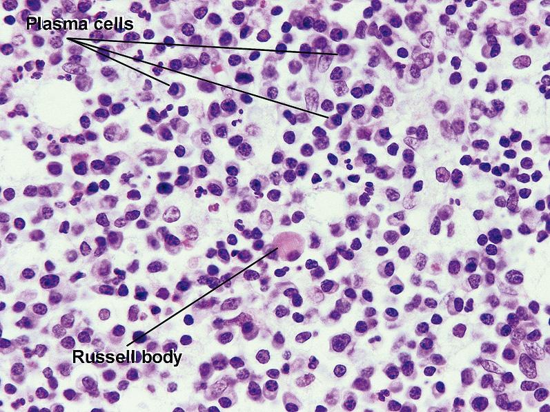 Fig. 1.32, Russell body, rhinoscleroma