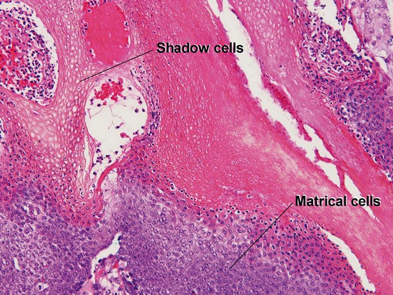 Fig. 1.33, Shadow cells, pilomatricoma