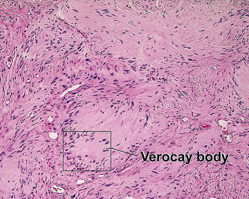 Fig. 1.35, Verocay body, schwannoma