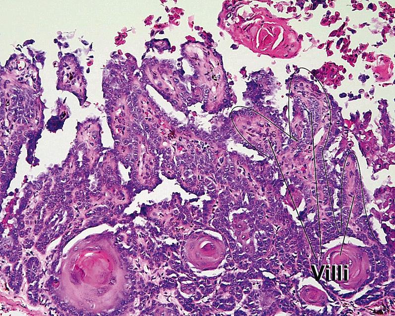 Fig. 1.36, Villi, warty dyskeratoma