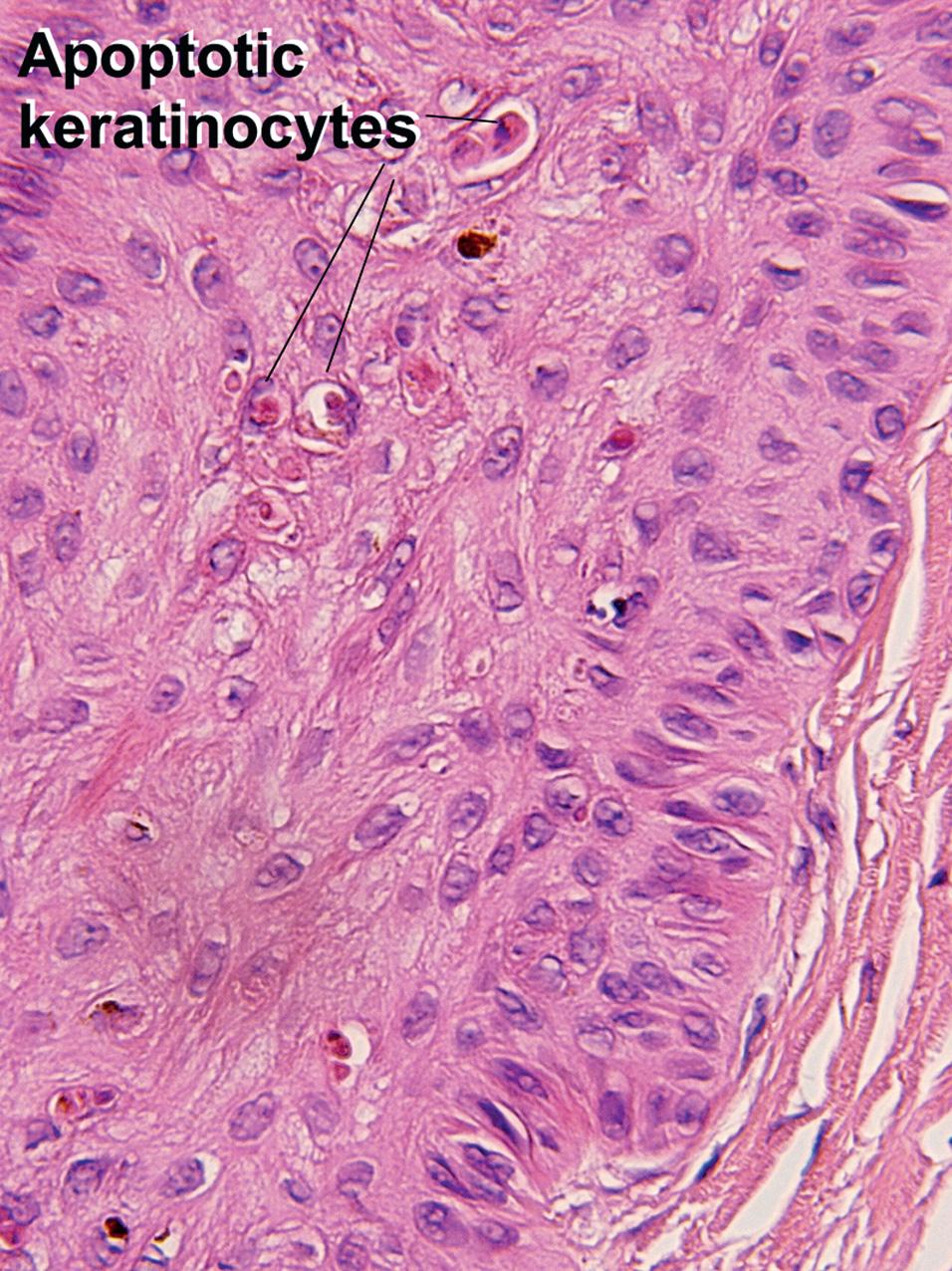 Fig. 1.4, Apoptosis, outer root sheath, catagen follicle