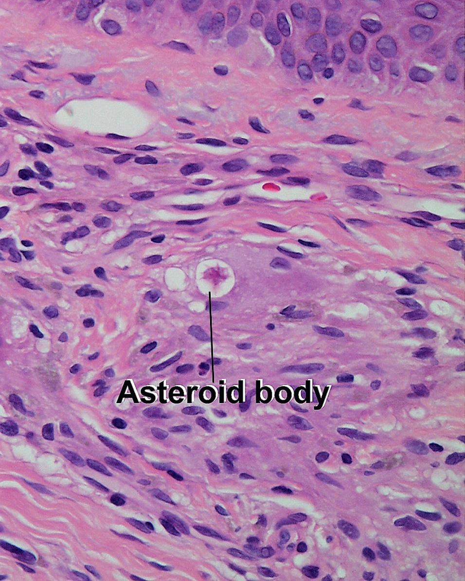 Fig. 1.5, Asteroid body, sarcoidosis