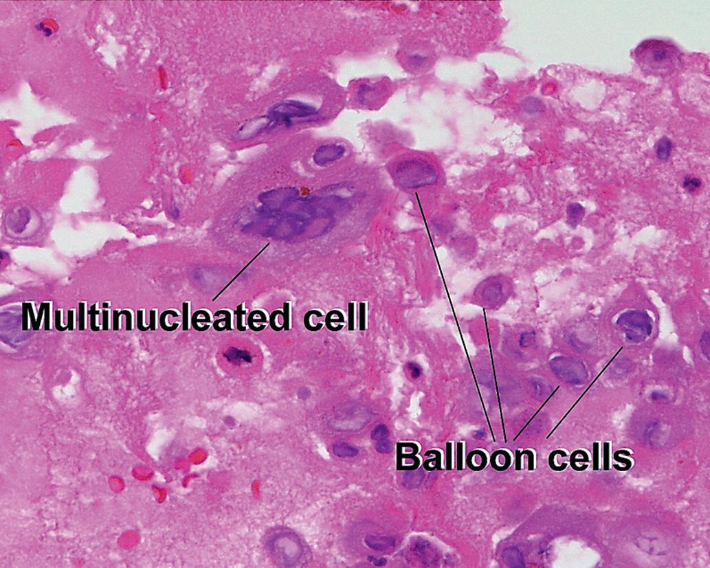 Fig. 1.6, Ballooning degeneration, herpes simplex