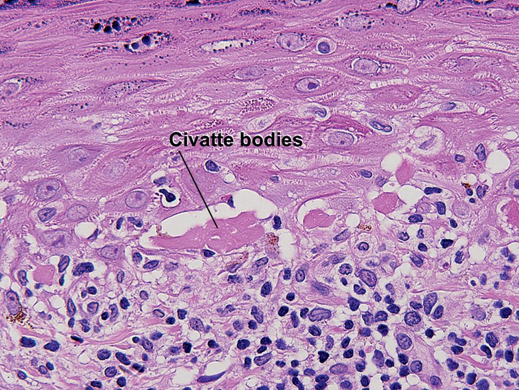 Fig. 1.7, Civatte bodies, lichen planus
