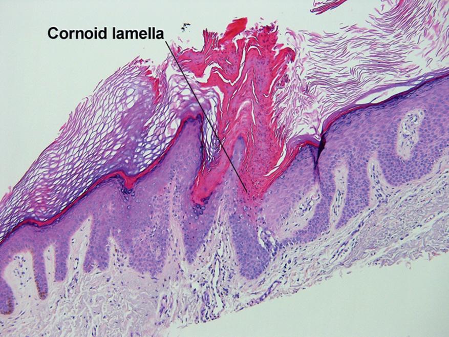 Fig. 1.9, Cornoid lamellae, porokeratosis