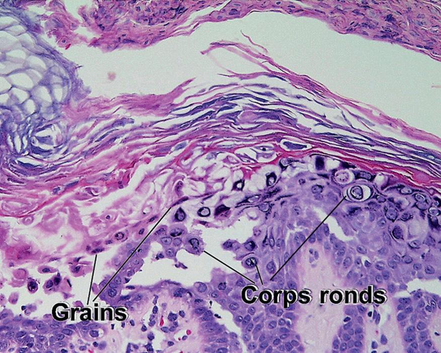 Fig. 1.10, Corps ronds/grains, Darier disease