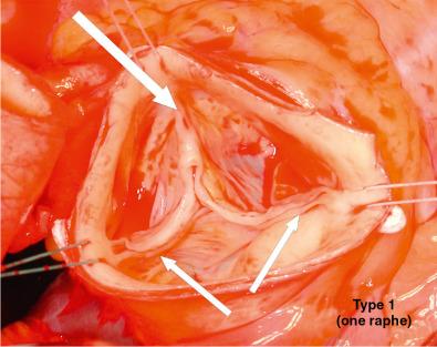 Fig. 11.2, Intraoperative Picture of a Bicuspid Aortic Valve.