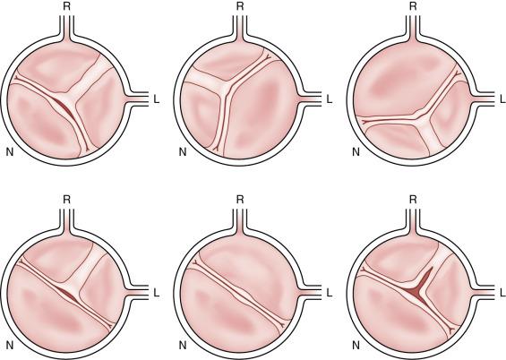 Fig. 11.3, Schematic of Bicuspid Aortic Valve (BAV) Phenotypes as Seen by Transthoracic Echocardiography.