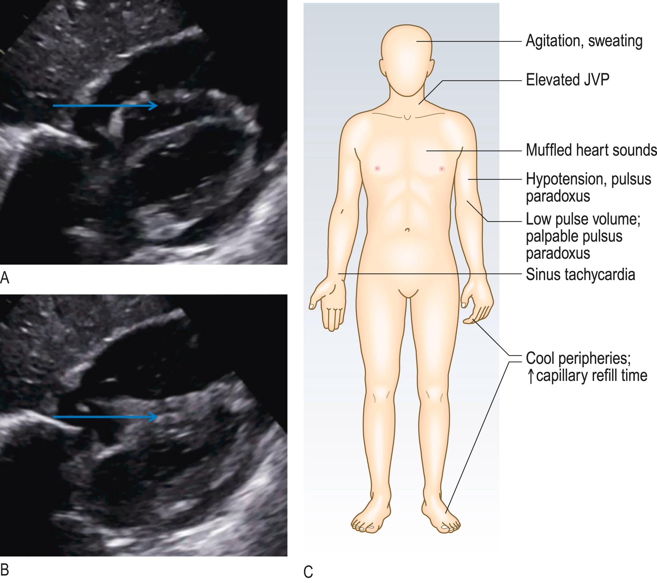 Fig. 4.11, Clinical and echocardiographic features of cardiac tamponade.