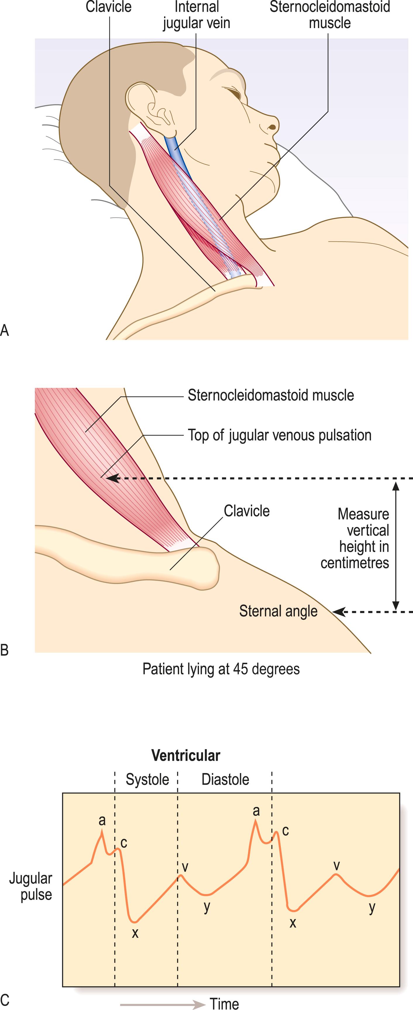 Fig. 4.15, Jugular venous pressure.