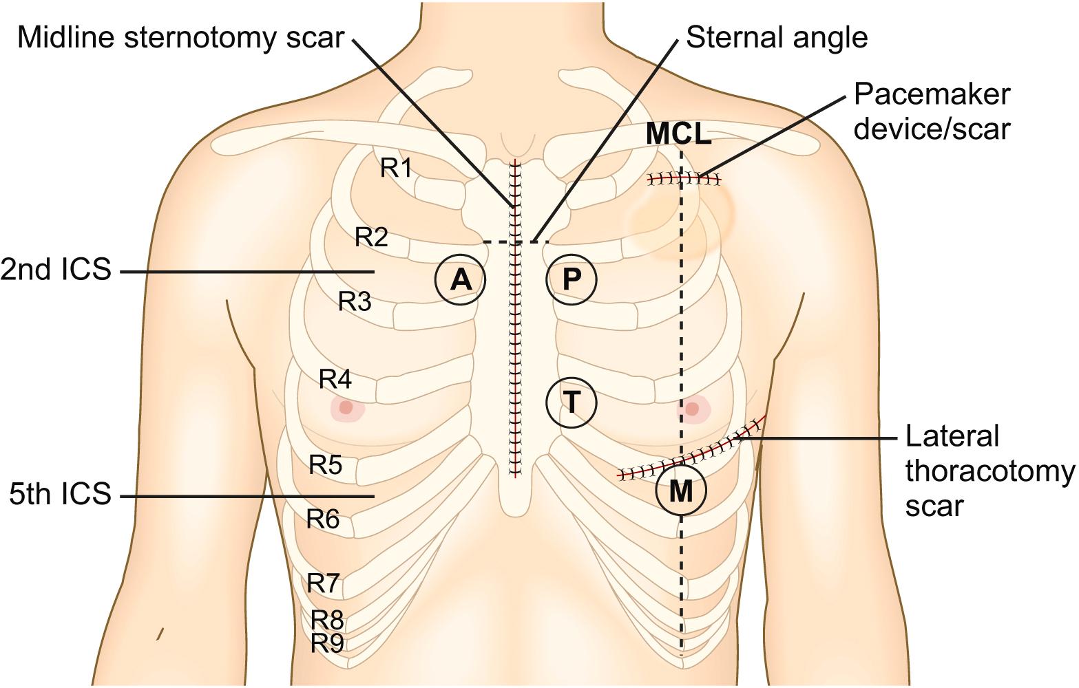 Fig. 4.16, Surface anatomy of the praecordium with common scars, anatomical landmarks and areas for auscultation. A, Aortic area; M, mitral area; P, pulmonary area; T, tricuspid area; R, rib; ICS, intercostal space; MCL, mid-clavicular line.