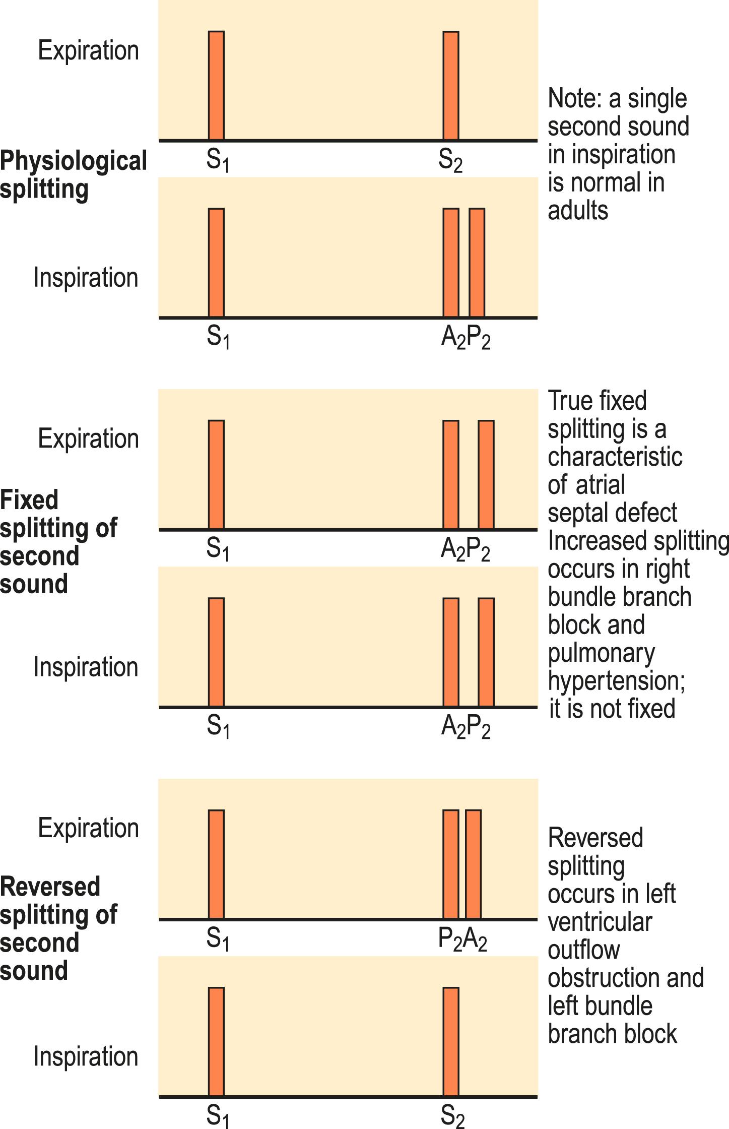 Fig. 4.19, Physiological and pathological splitting of the second heart sound.