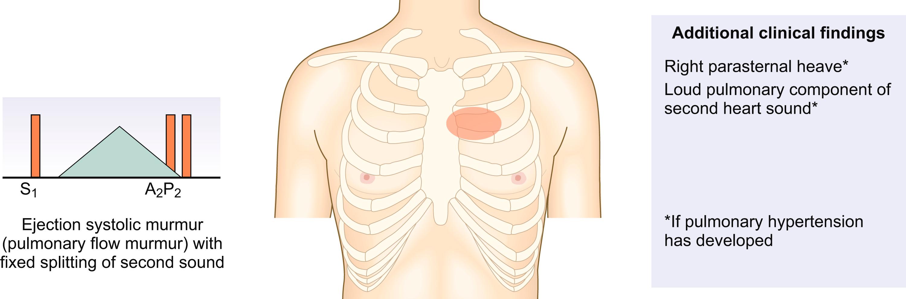 Fig. 4.20, Atrial septal defect. The increased blood flow through the right heart resulting from the left to right shunt produces a pulmonary flow murmur, best heard in the pulmonary area (left parasternal edge, second intercostal space).