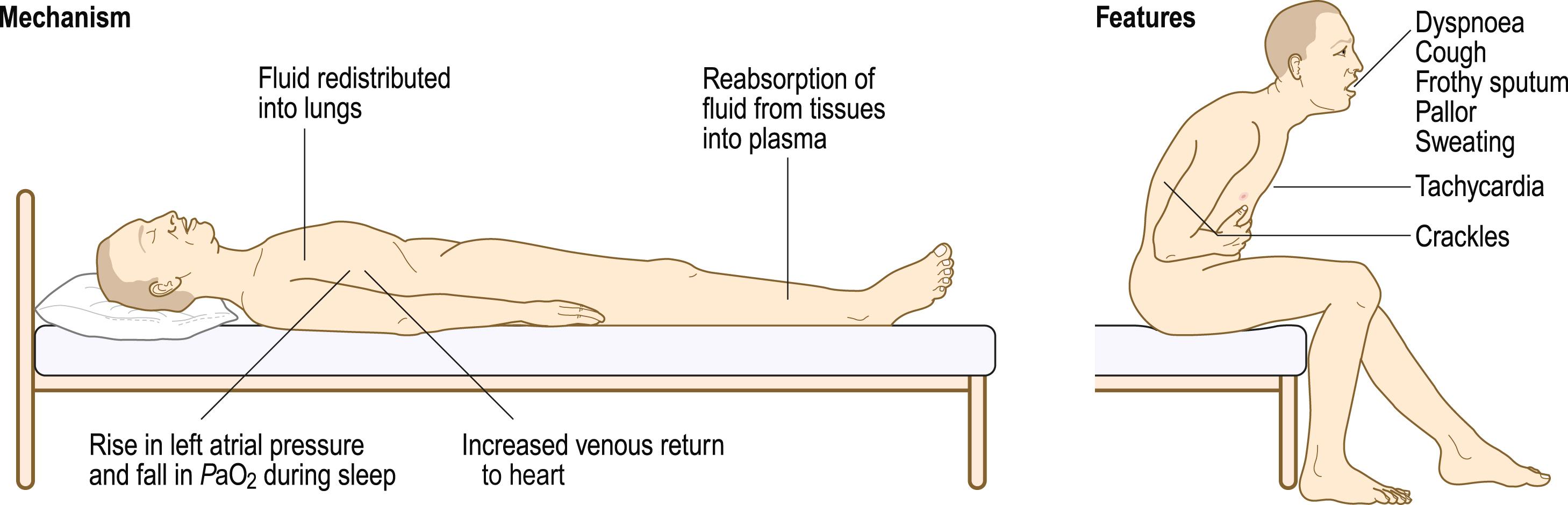 Fig. 4.3, Paroxysmal nocturnal dyspnoea.