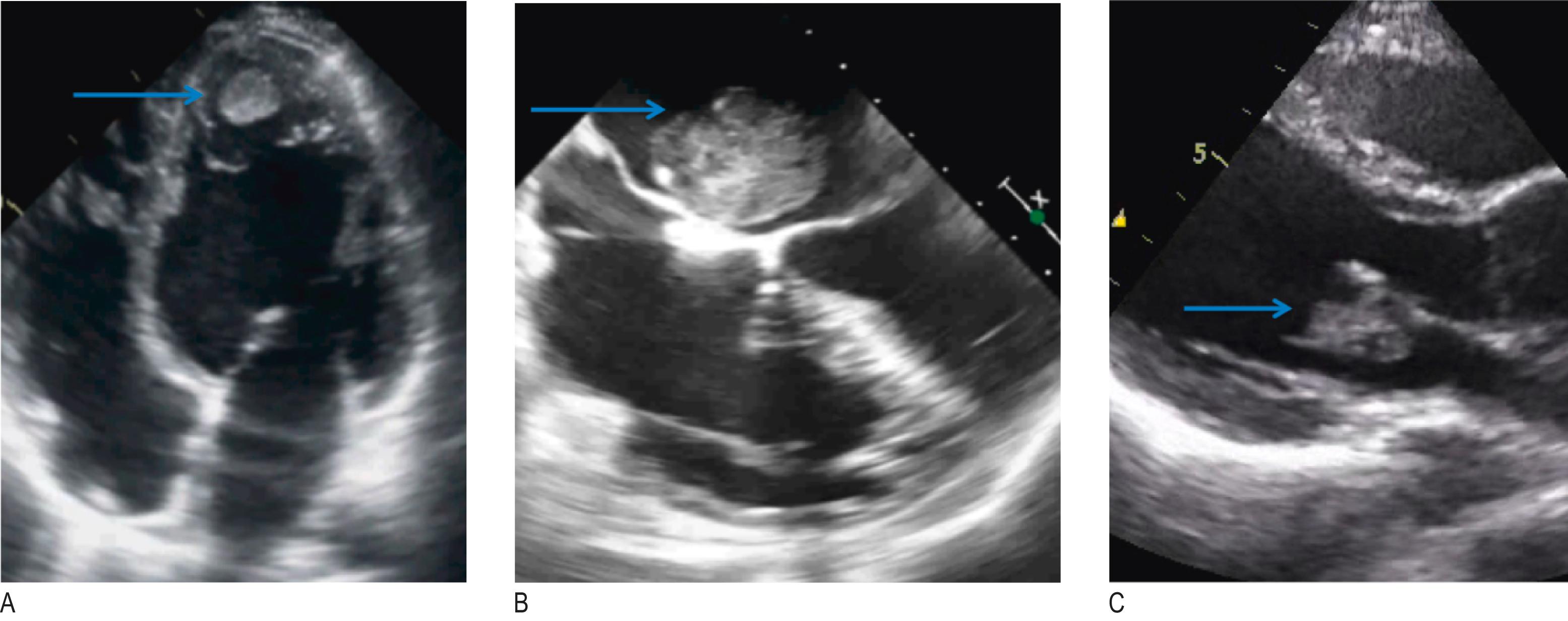 Fig. 4.4, Cardiac sources of systemic embolism: echocardiographic images.