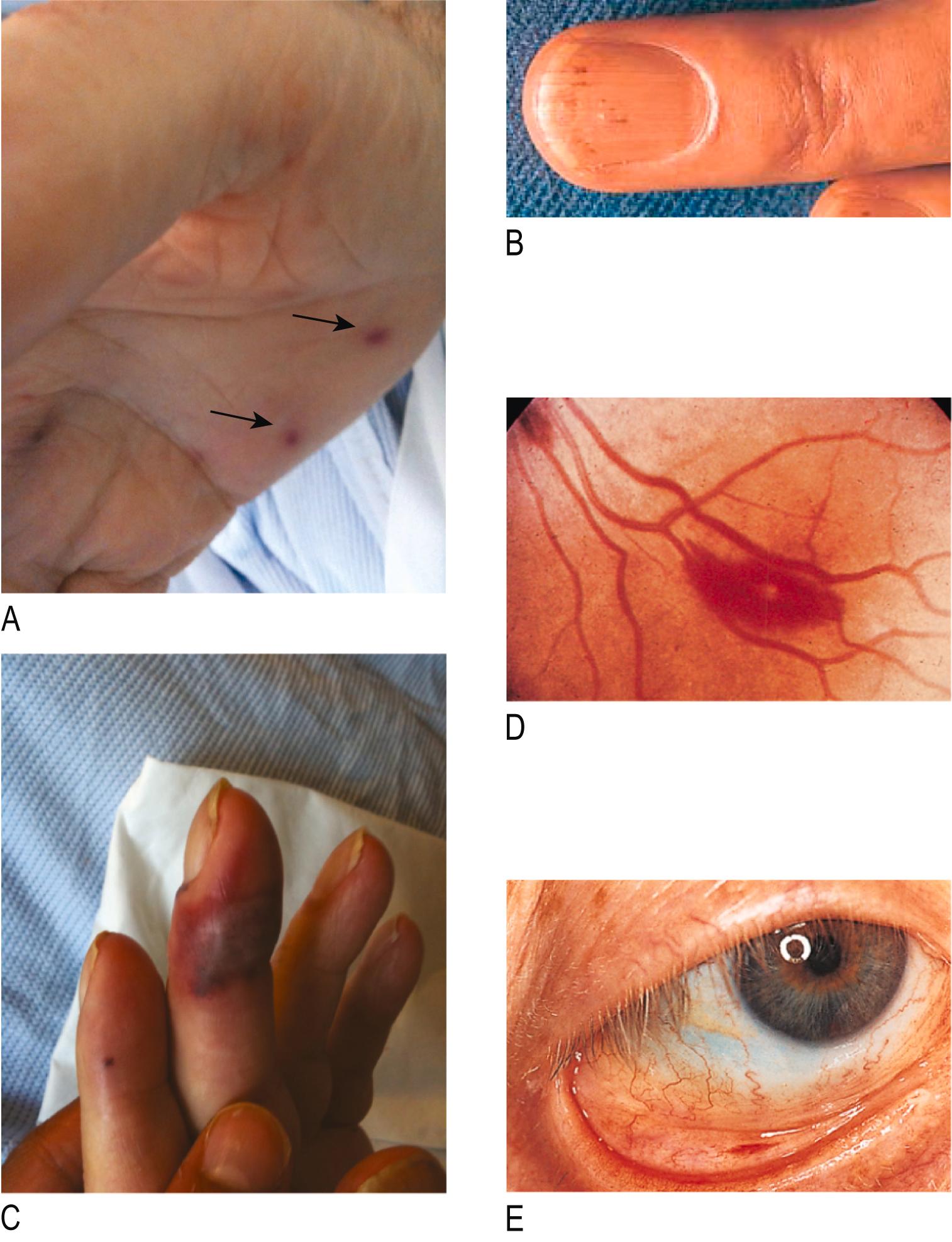 Fig. 4.5, Peripheral signs that may be present in infective endocarditis.