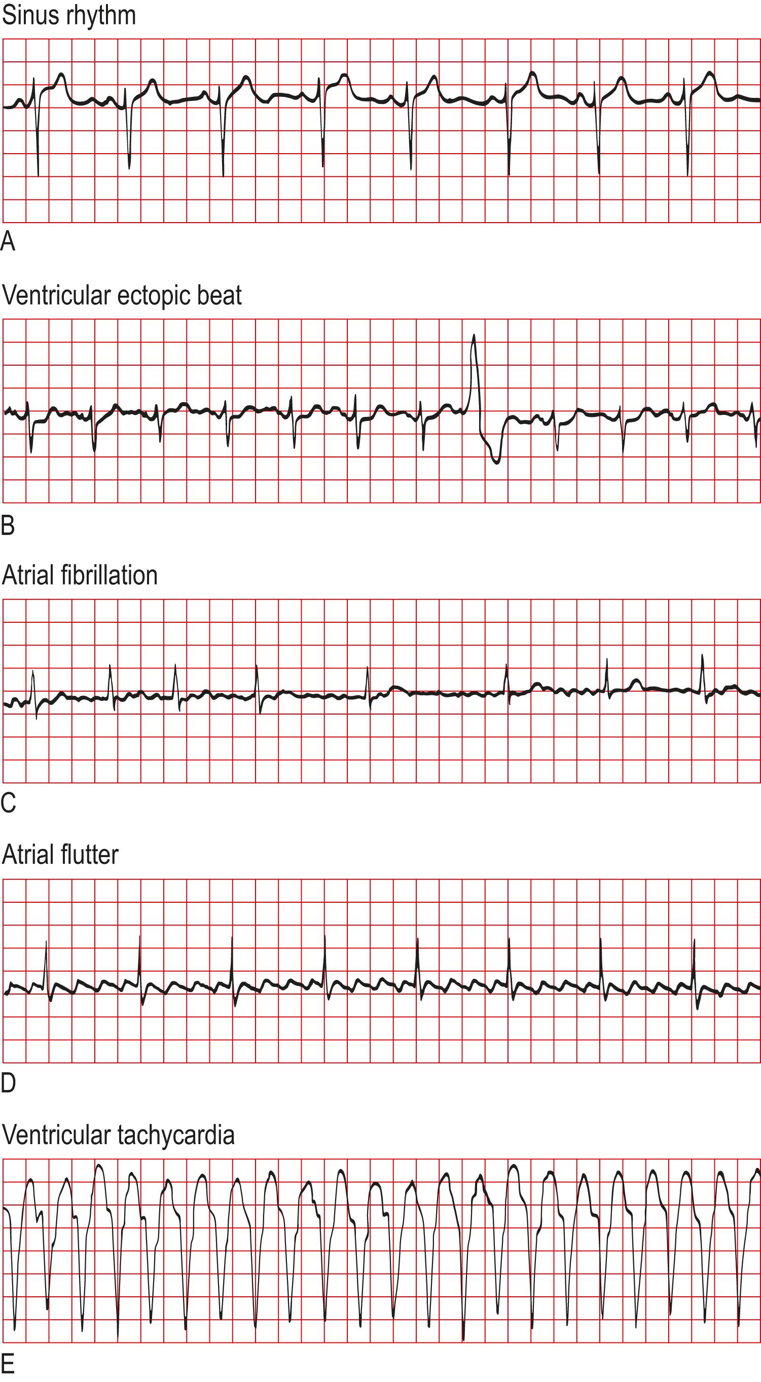 Fig. 4.8, Electrocardiogram rhythm strips.