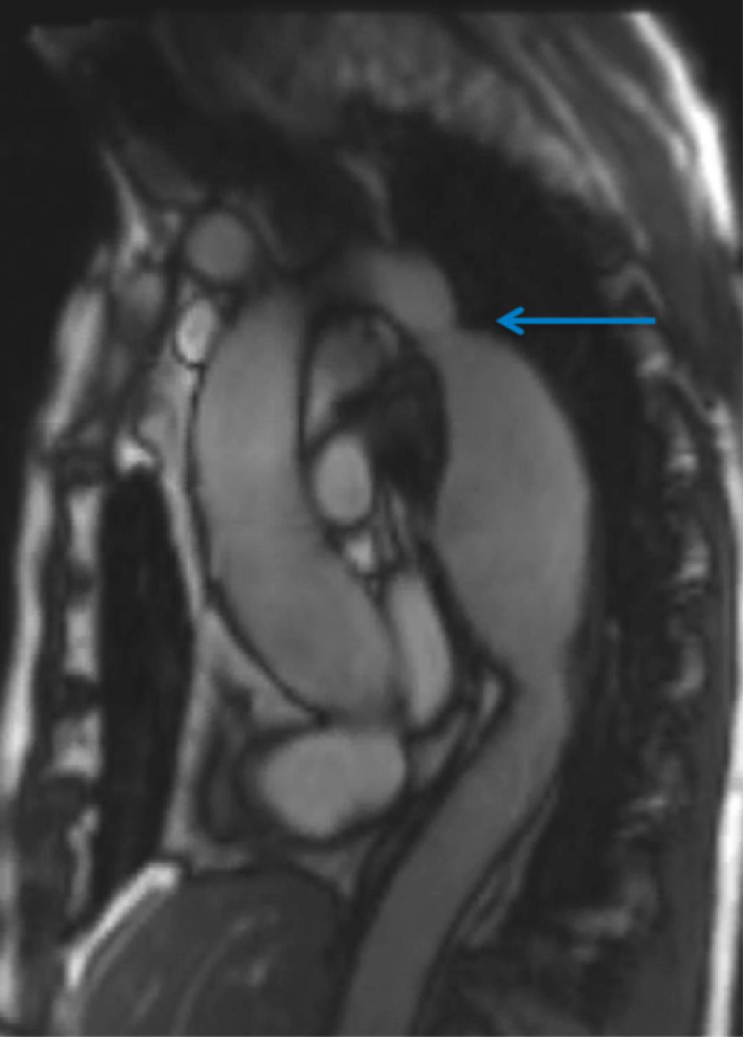 Fig. 4.9, Coarctation of the aorta. Magnetic resonance image showing the typical site of aortic coarctation, just distal to the origin of the left subclavian artery (arrow) . This explains why there is synchrony of the radial pulses but radiofemoral delay.