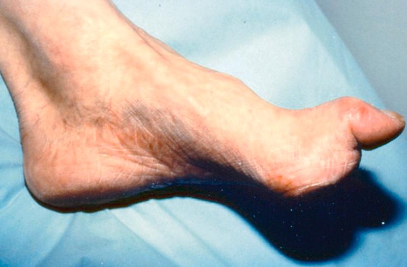 Figure 5.1, Typical appearance of a neuropathic foot, with clawed toes, dry skin, callouses and prominent metatarsal heads.