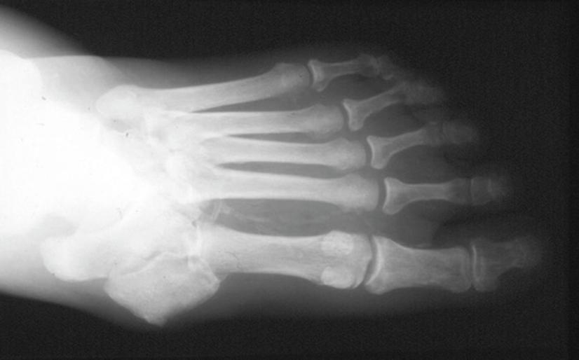 Figure 5.2, Calcification of the foot arteries in a patient with diabetes and neuropathy. This may falsely elevate Doppler pressures even within the normal range.