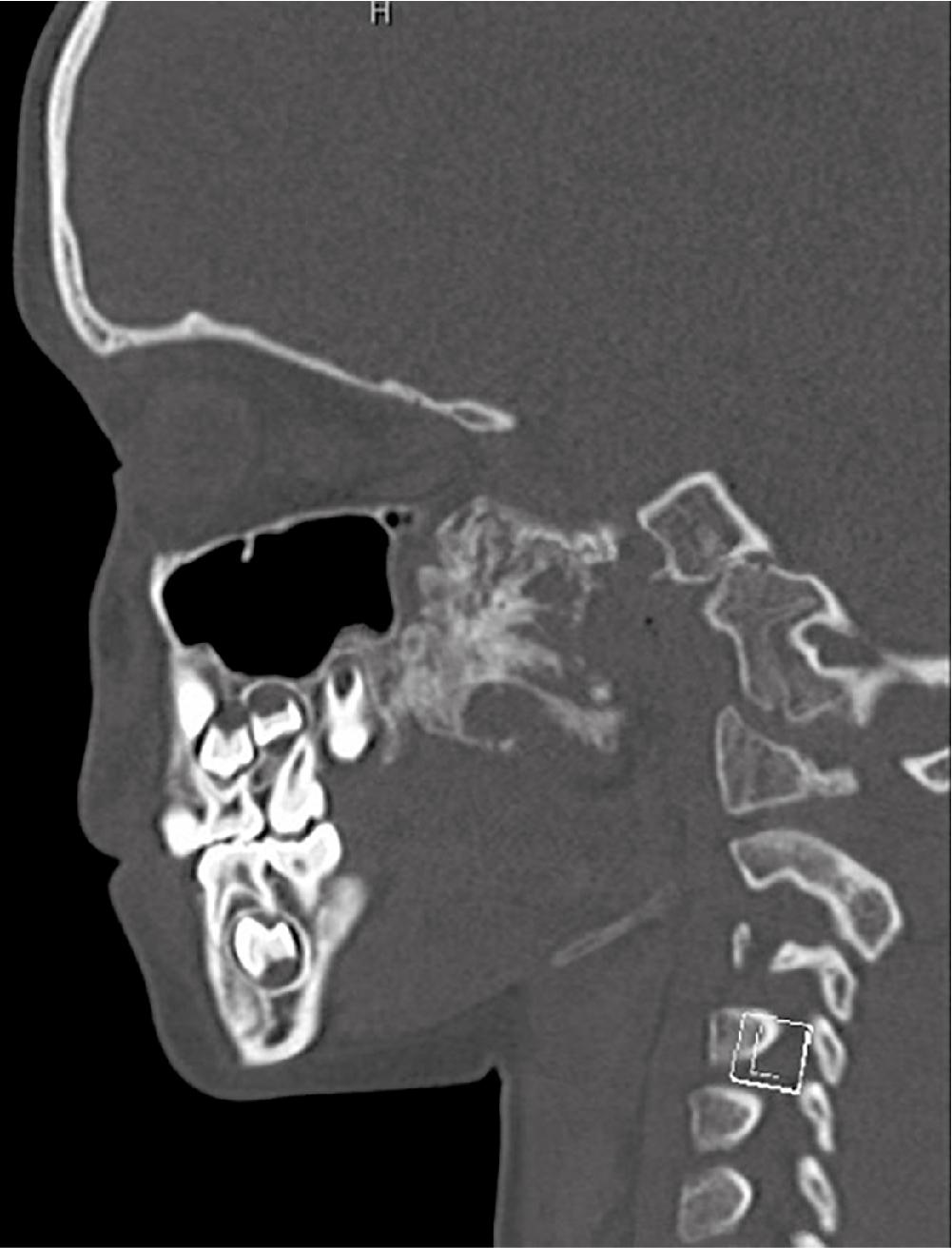 Fig. 1.1, Sagittal section CT scan of a 6-year-old male with a large, calcified mass in left pterygomaxillary region.