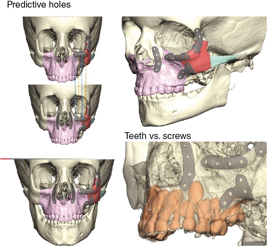 Fig. 1.2, A 6-year-old male patient with osteosarcoma of the left pterygomaxillary region. KLS Martin preoperative planning shows planned osteotomies and position of tooth roots in relation to plates/screws. Intraoperatively, we found that the LeFort osteotomy was not required, as access to the tumor was adequate through removal of the zygoma and zygomatic arch.