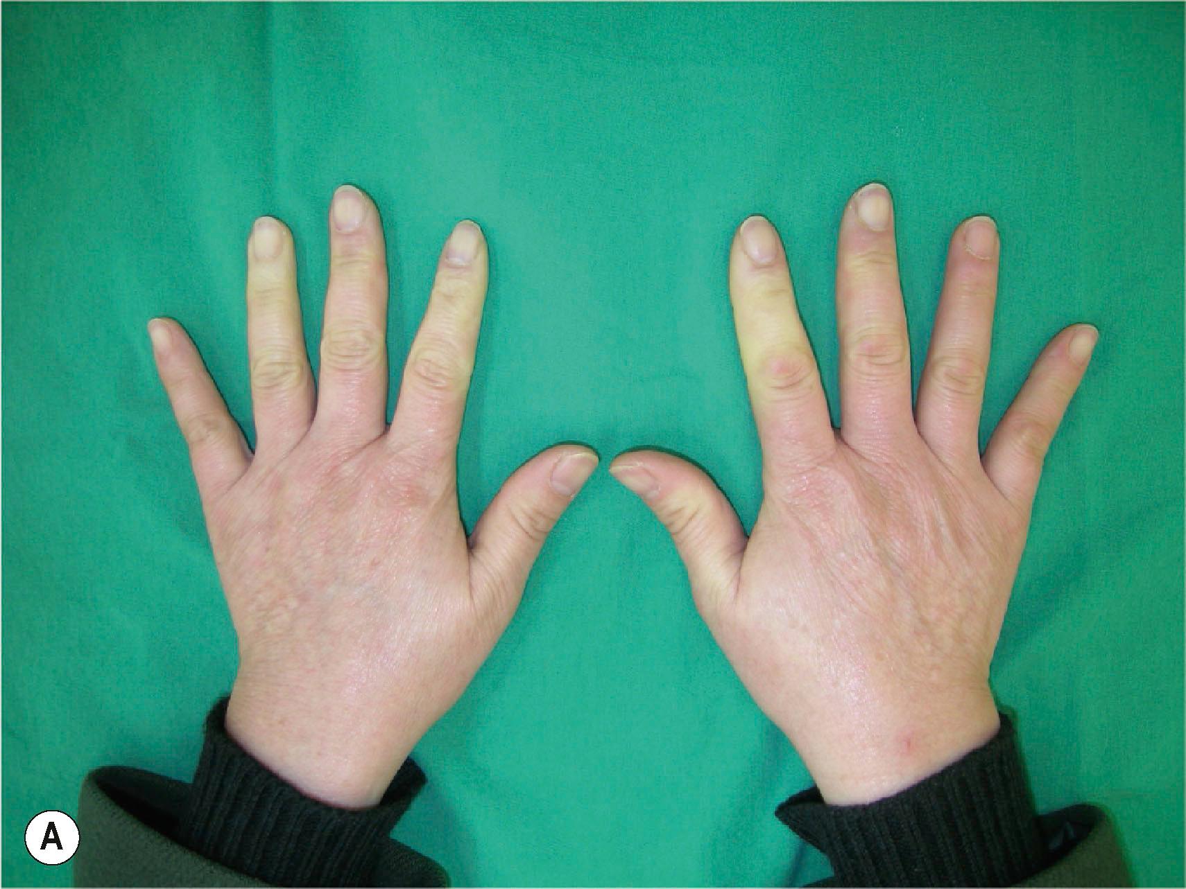 Figure 28.1, Triphasic color changes. (A) Fingers turn white. (B) Fingers turn purple.