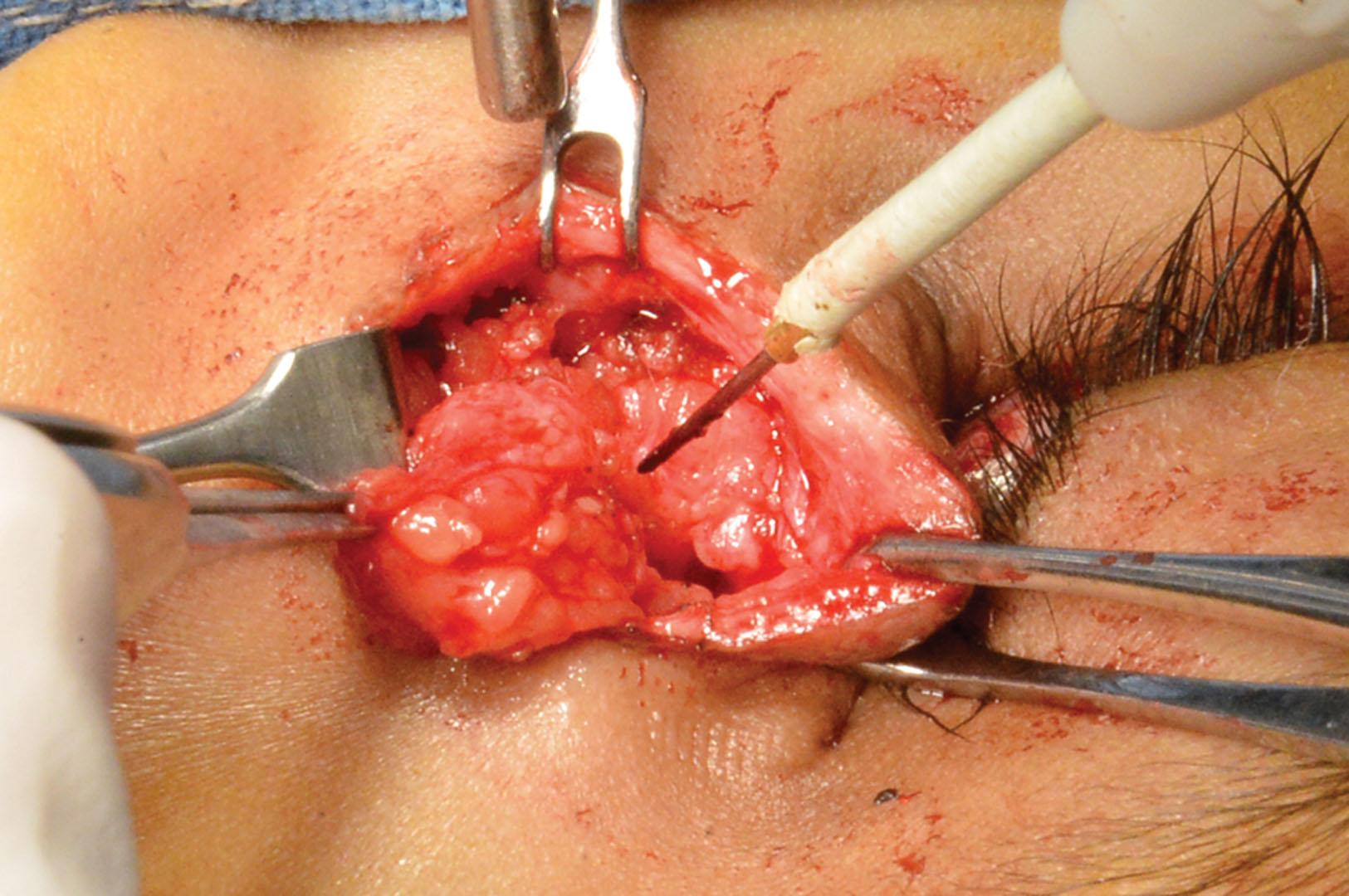 Fig. 18.2, Intraoperative image of an ectopic lacrimal gland within the lacrimal sac.