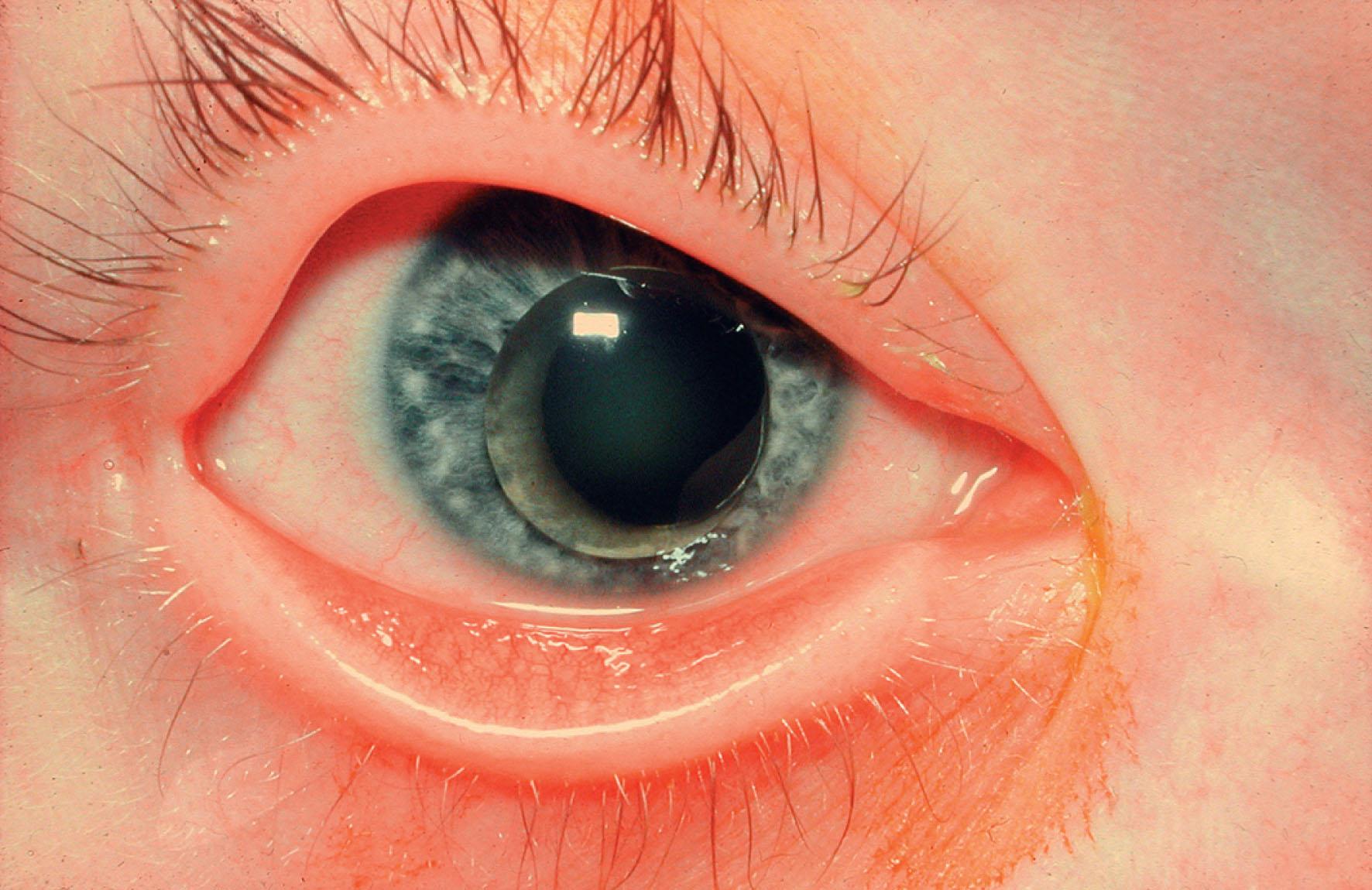 Fig. 34.1, Weill–Marchesani syndrome (WMS). Microspherophakia with anterior lens dislocation.