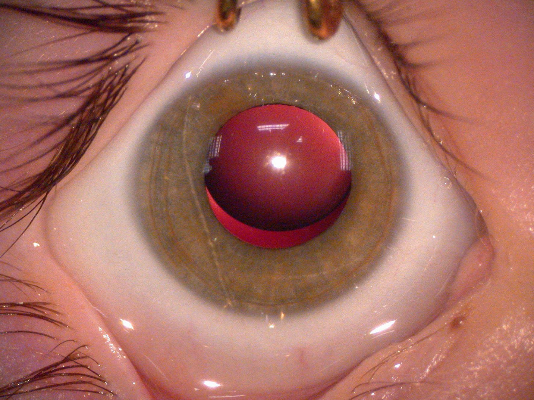 Fig. 34.2, Traboulsi syndrome (ASPH mutations). Microspherophakia and upward lens subluxation.