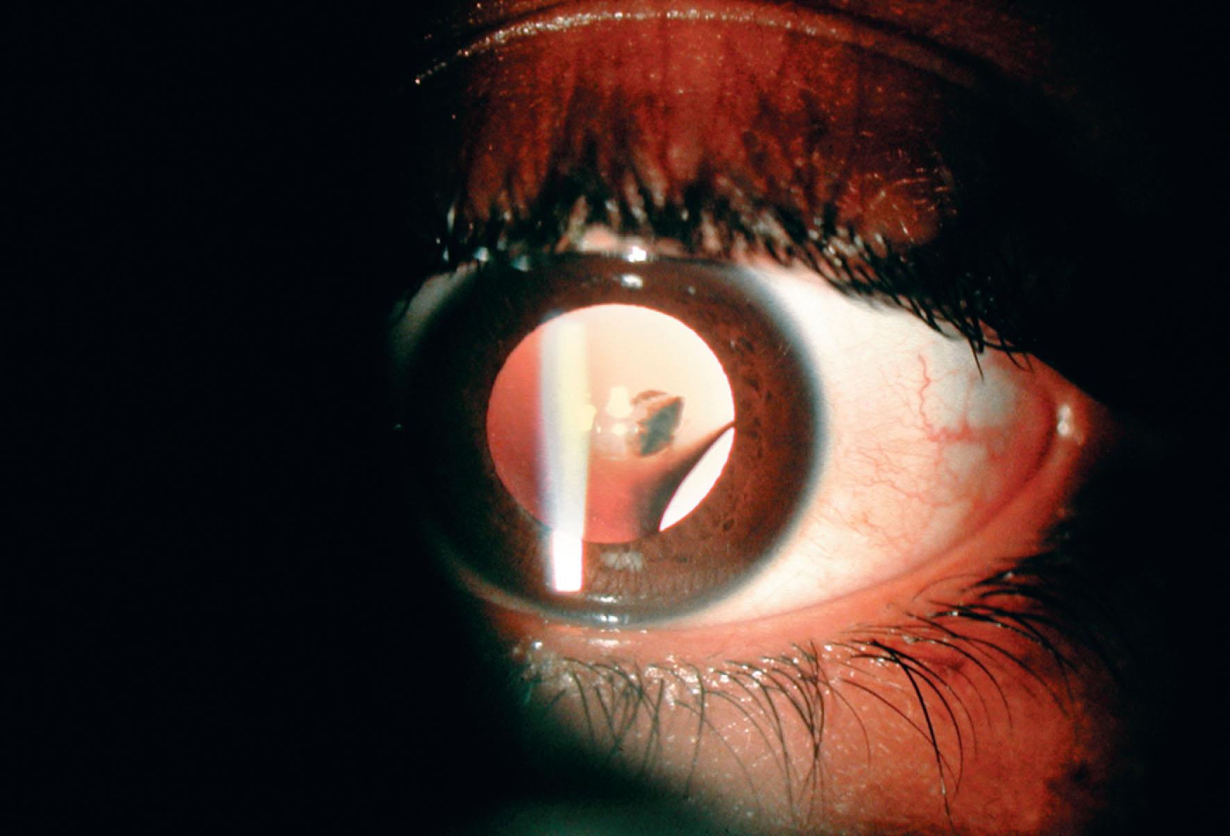 Fig. 34.3, Lens coloboma. Note small cataract adjacent to the coloboma.