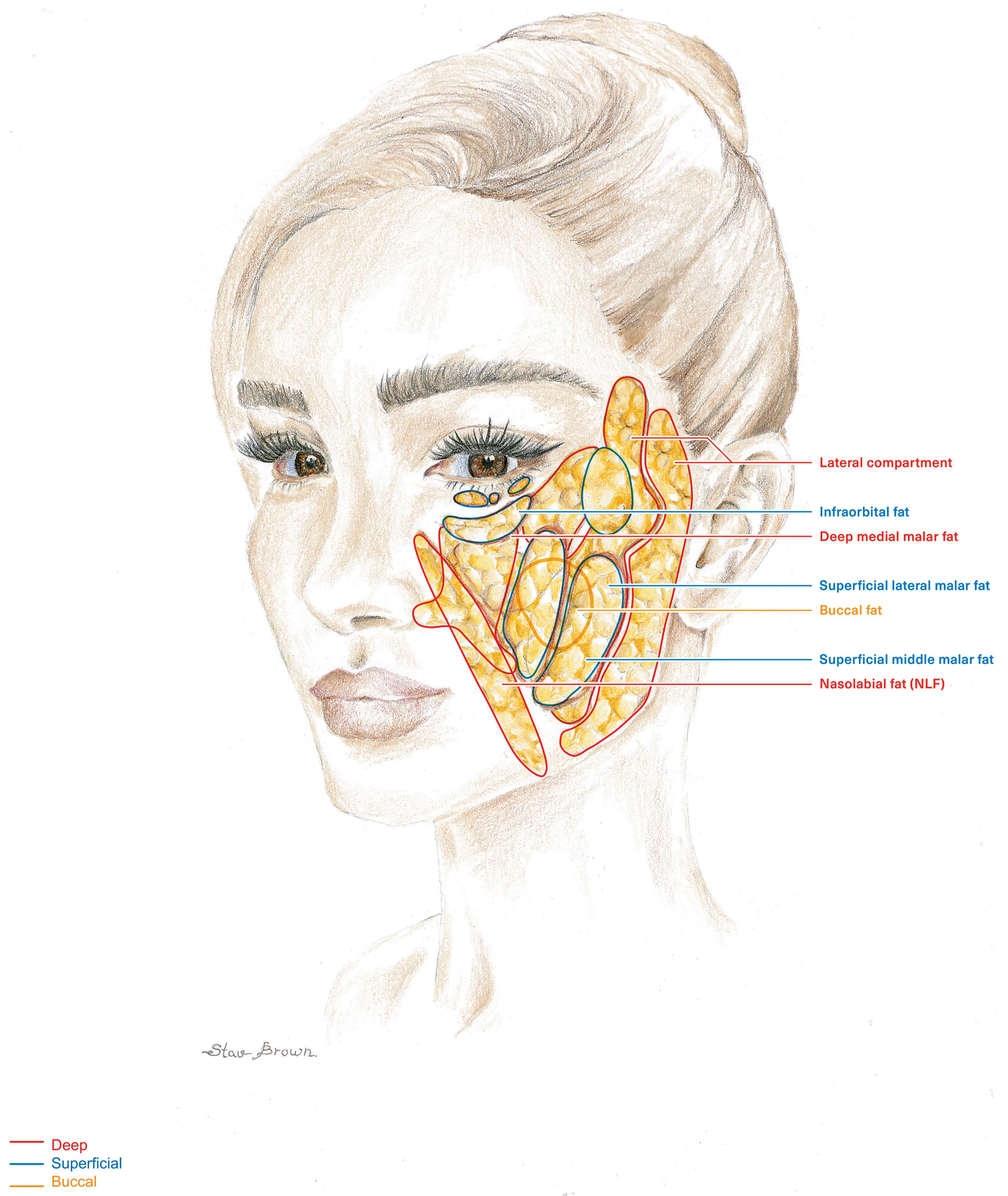 Figure 9.9.1, Fat compartments. The superficial fat compartments of the cheek include the superficial middle and lateral malar fat. The deep midfacial fat compartments include the deep medial malar fat and the nasolabial fat.