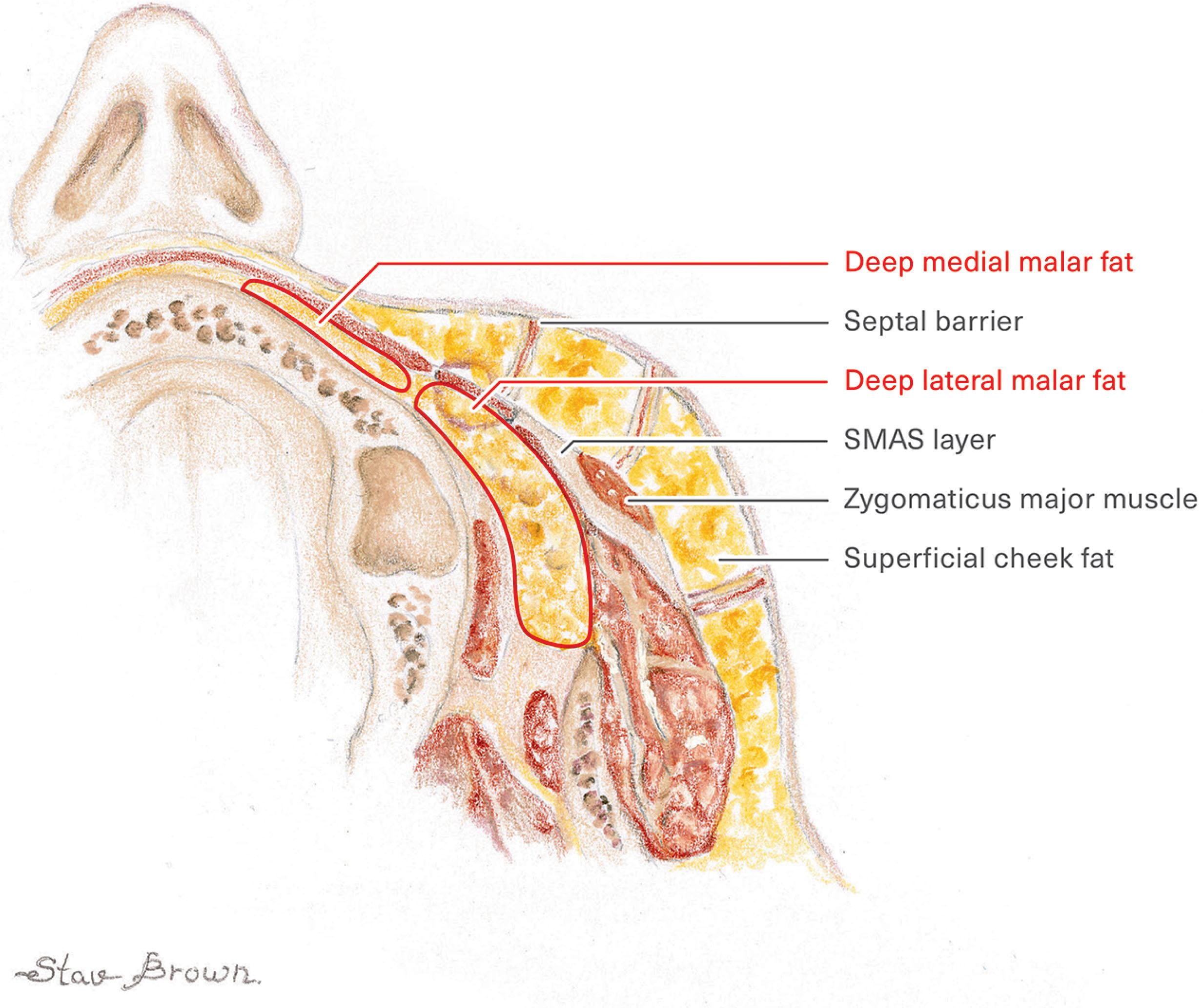 Figure 9.9.2, Cross-section illustrating the superficial and deep malar fat compartments relative to the SMAS layer. The superficial cheek fat pads are separated by septal barriers arising from the SMAS, whereas the deep malar fat pads lie deep to and separate from the SMAS.