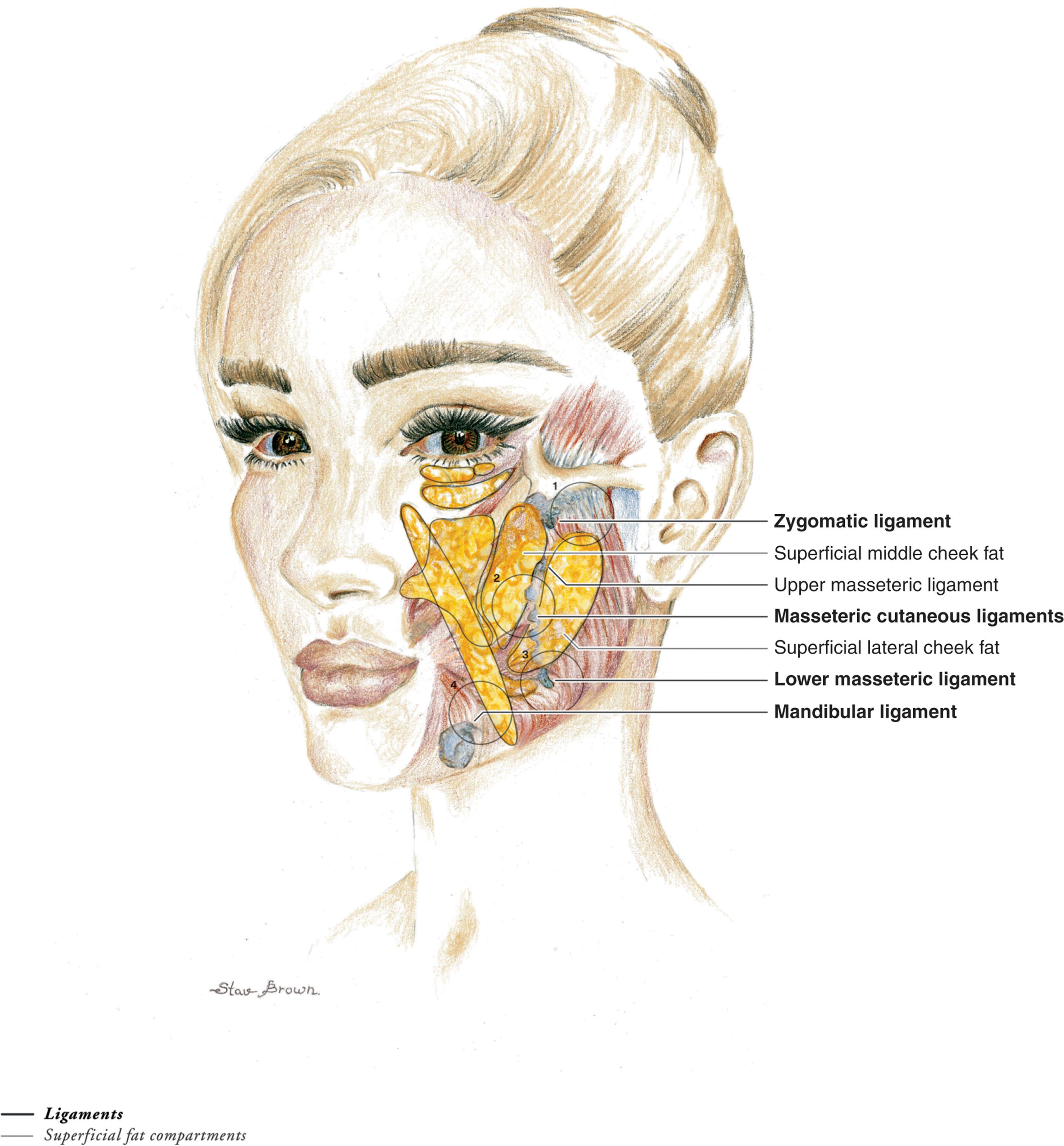 Figure 9.9.3, Retaining ligaments and danger zones. The three major retaining ligaments of the face are the zygomatic ligament, the mandibular ligament, and the masseteric cutaneous ligaments. Four danger zones are encountered in facelift dissection where facial nerve branches are especially vulnerable to injury. These danger zones occur in transition points between superficial fat compartments or in areas of dense retaining ligaments. (1) The first danger zone lies between the region of the zygomatic and the upper masseteric ligaments. The zygomatic branch of the facial nerve becomes relatively superficial here and is vulnerable to injury. (2) The second danger zone lies anterior to the parotid, in the transition from the superficial lateral to middle cheek fat compartment. The buccal branch of the facial nerve is vulnerable to injury in this loose areolar plane. (3) The third danger zone lies in the region of the lower masseteric ligaments. The marginal mandibular branch of the facial nerve is vulnerable to injury here as it exits the tail of the parotid. (4) The fourth danger zone is in the region of the mandibular ligament. Dissection past the cheek–chin junction should proceed with caution in this highly vascular zone.