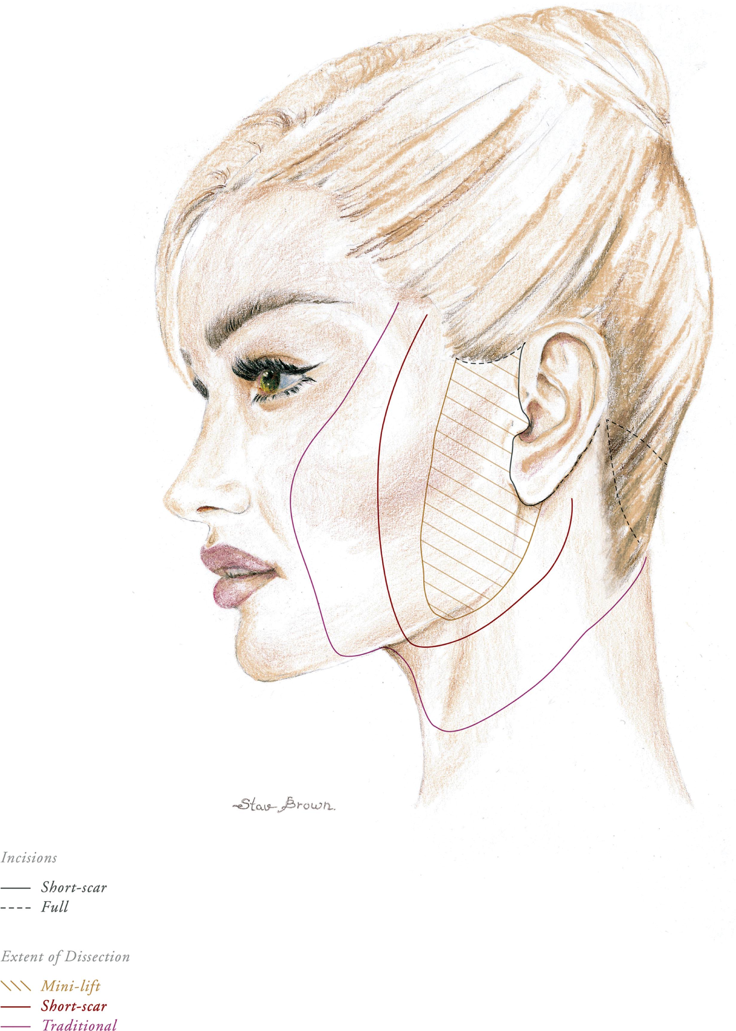 Figure 9.9.4, Facelift classifications. Short-scar and mini-lifts use limited skin incisions in the pre-auricular area (black solid line). Traditional facelifts use full-length skin incisions that extend into the temporal and occipital scalp (black dotted line). The extent of dissection performed in the mini-lift is minimal in the face and typically does not involve the neck (green striped area). The extent of dissection in the short-scar lift is somewhat greater in the cheek and may extend partially into the neck (red line). The extent of dissection in the traditional facelift typically involves the full face and neck (purple line).