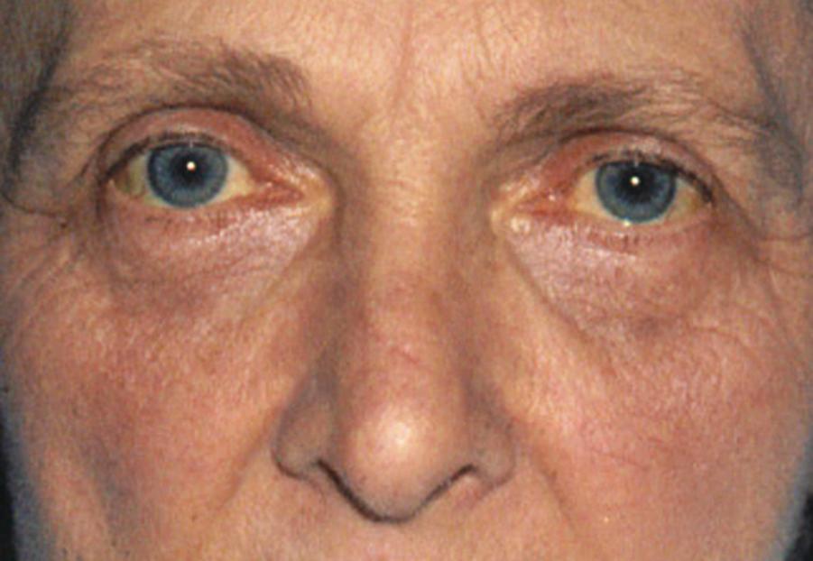 Fig. 15.3, Patient demonstrating the features of jaundiced skin and sclera.