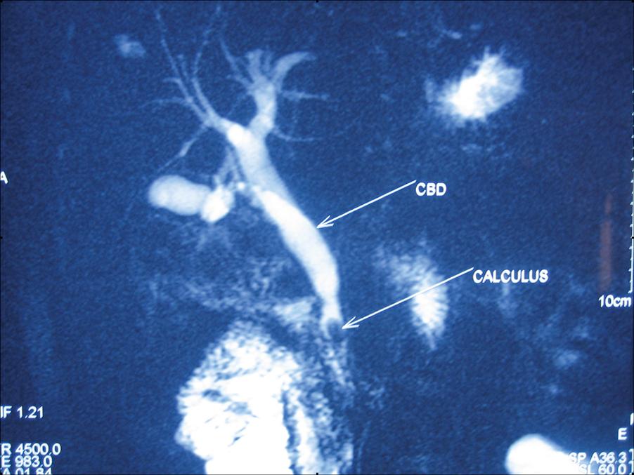 Fig. 15.6, Magnetic resonance cholangiopancreatography showing a stone in the common bile duct seen as a filling defect.