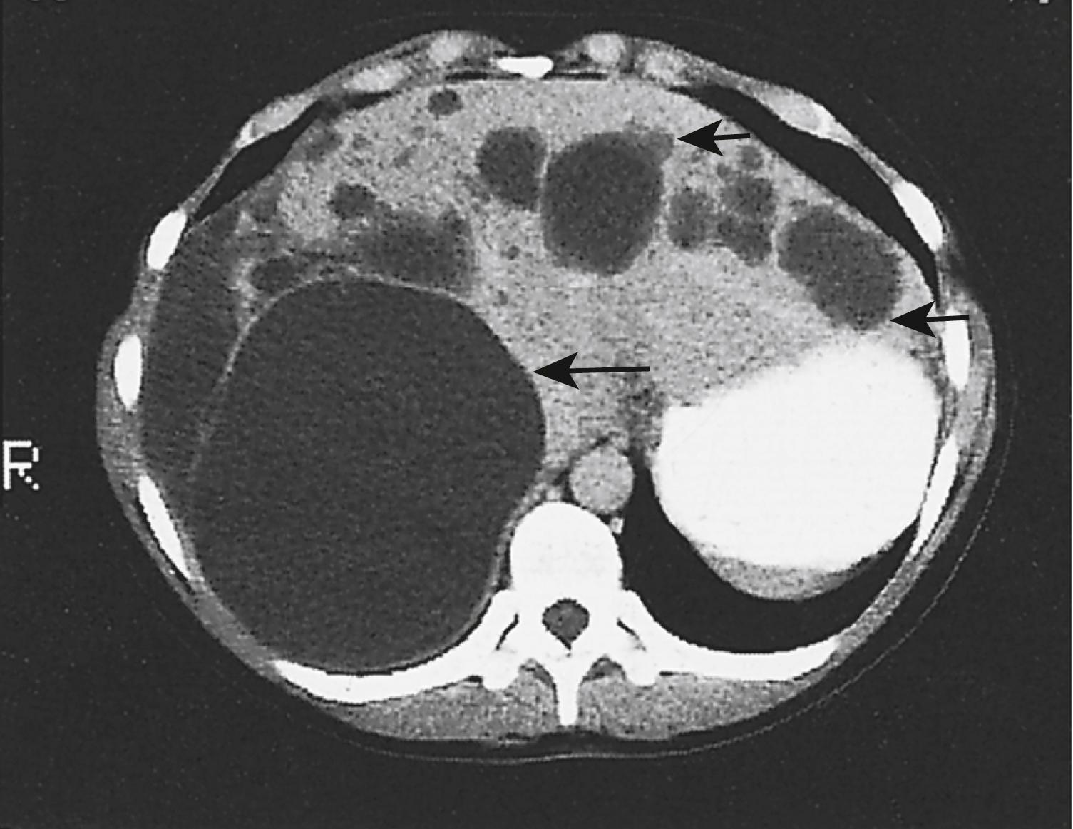 Fig. 15.7, CT demonstrating multiple biliary cysts appearing as hypodense areas within both lobes of the liver ( arrowed ).