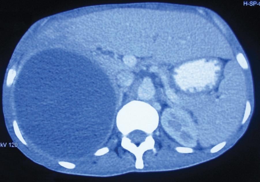 Fig. 15.8, Contrast-enhanced (oral and intravenous) CT showing large abscess replacing the right lobe of the liver.