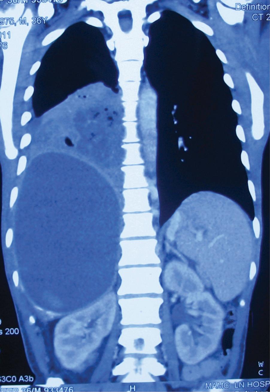 Fig. 15.9, Contrast-enhanced CT showing a massive amoebic liver abscess with rupture into pleural cavity and lungs. The patient presented with severe toxic symptoms and anchovy sauce-coloured expectoration.