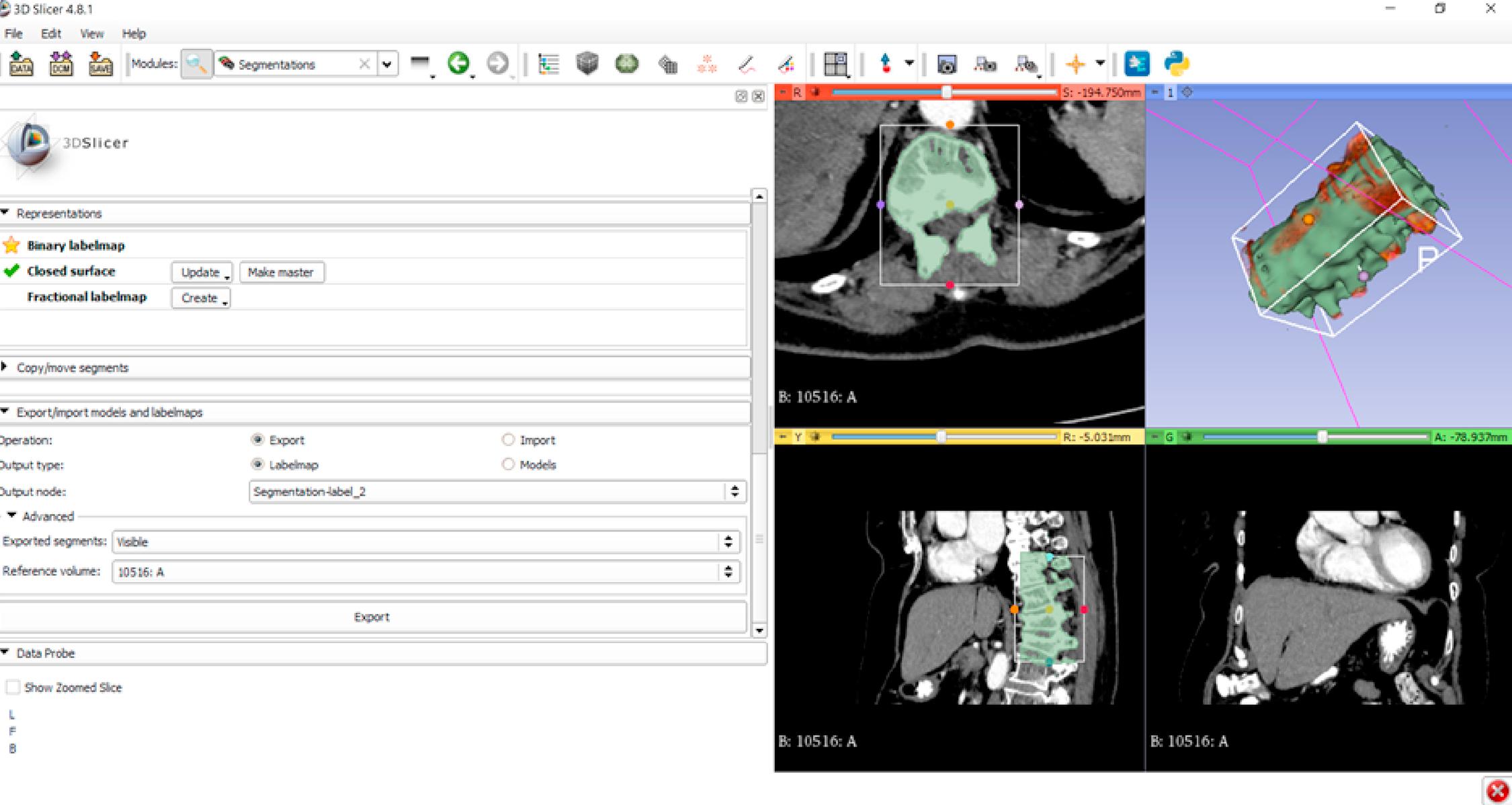 Figure 2.1, Workspace in 3D Slicer during the production of 3D bone model and specific part of the spine from CT.