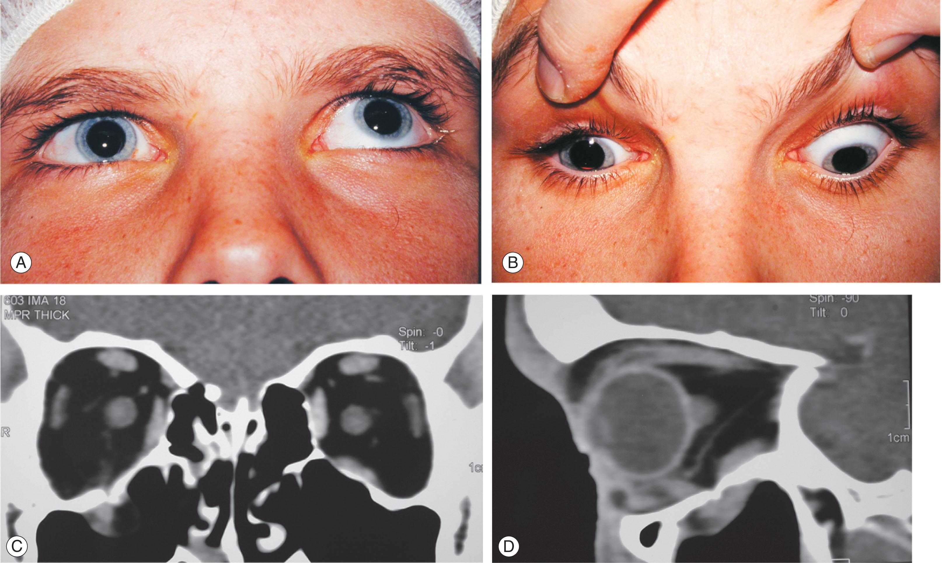 Fig. 19.6, A child following blunt right orbital trauma with marked restriction of upgaze (A) and downgaze (B) and a small orbital floor fracture (C and D) with entrapment of the right inferior rectus muscle.