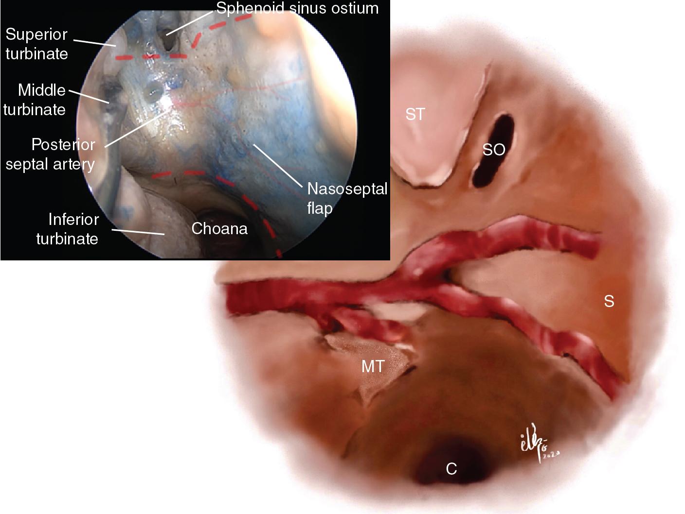 Fig. 29.1, Posterior septal artery bifurcates into superior and inferior branches. C, Choana; MT, middle turbinate, S, septum; SO, sphenoid OS; ST, superior turbinate.