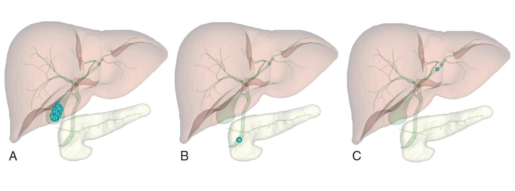 FIGURE 33.1, Common sites for stone formation and obstruction within the biliary system.