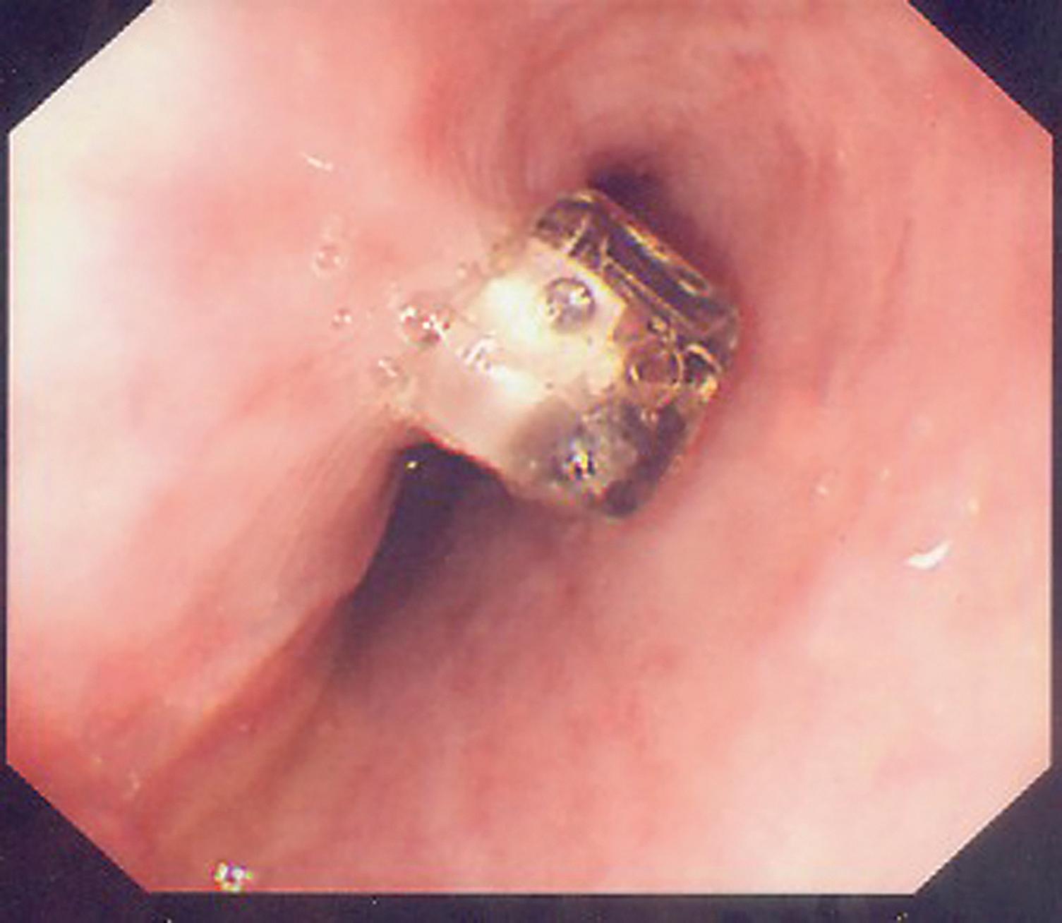 Fig. 14.11, Endoscopic view of a wireless Bravo capsule clipped to the oesophageal mucosa 5 cm proximal to the gastrooesophageal junction. These record for up to 72 hours before falling off and passing harmlessly through the gut.