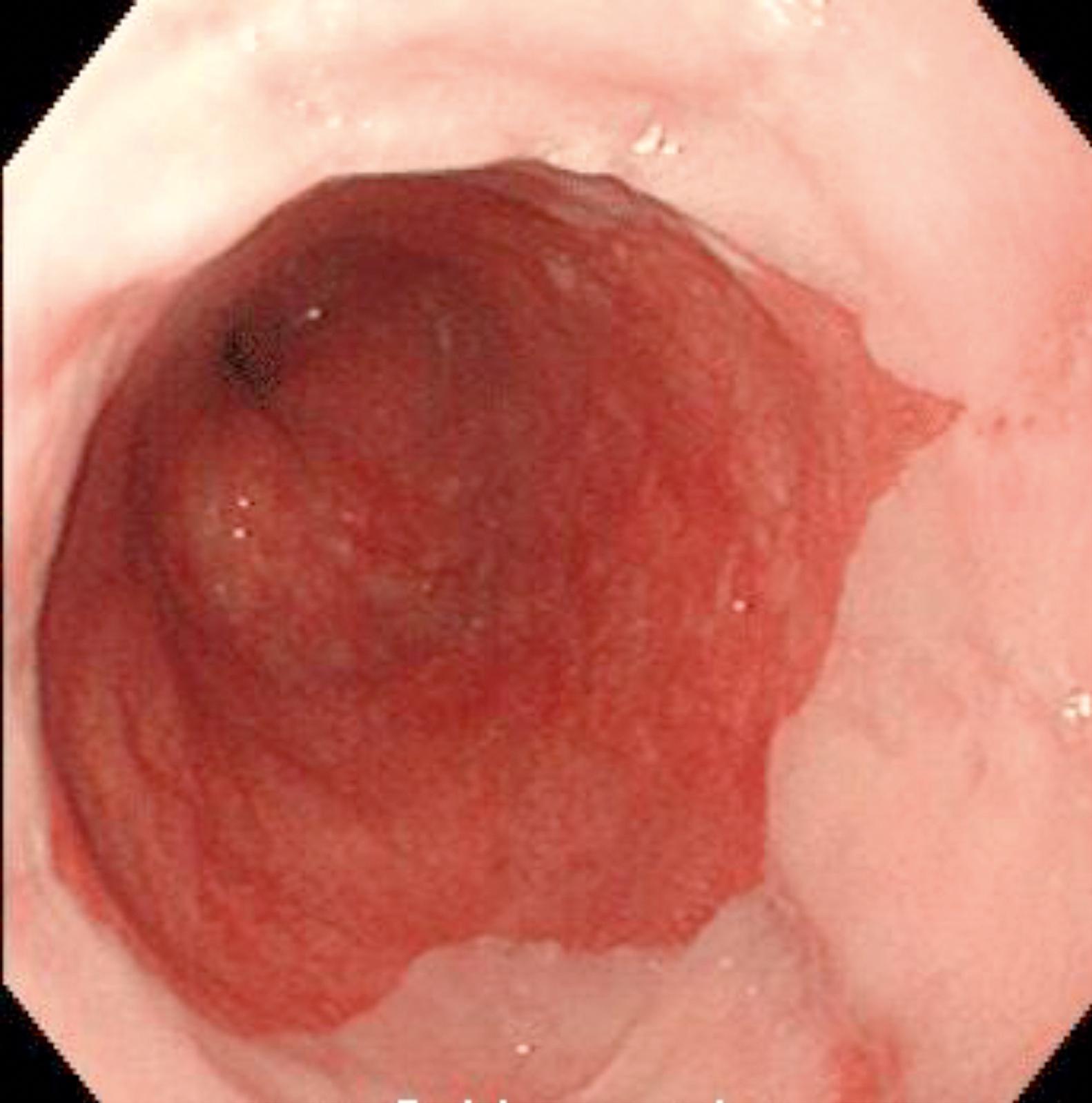 Fig. 14.12, Endoscopic appearance of circumferential Barrett oesophagus above the gastrooesophageal junction with proximal linear oesophagitis.